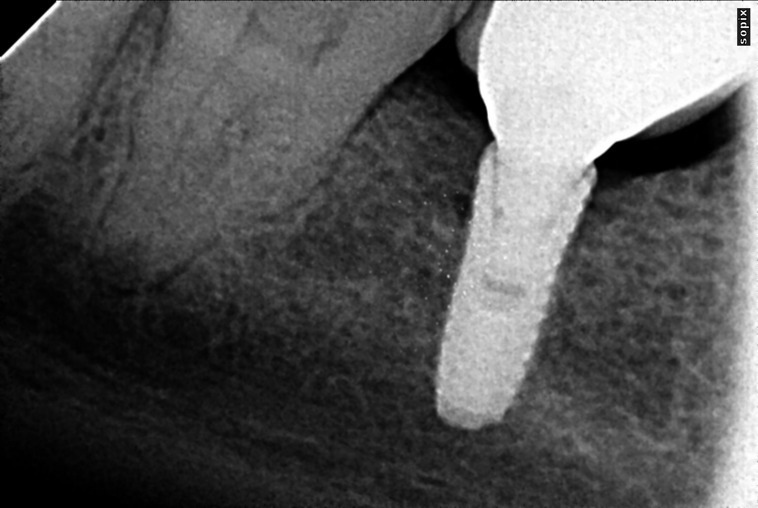 Dental Implants