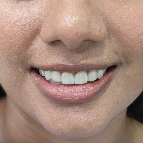 Smile Designing
